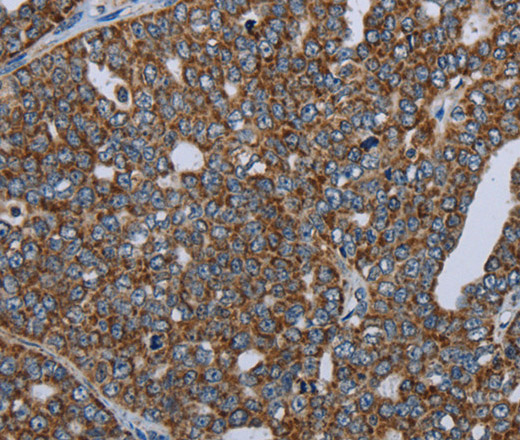 Immunohistochemistry of paraffin-embedded Human ovarian cancer using NDUFA13 Polyclonal Antibody at dilution of 1:50