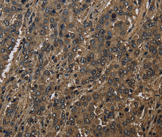 Immunohistochemistry of paraffin-embedded Human liver cancer using GSTO1 Polyclonal Antibody at dilution of 1:60