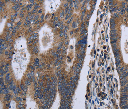 Immunohistochemistry of paraffin-embedded Human colon cancer using GSTA3 Polyclonal Antibody at dilution of 1:30