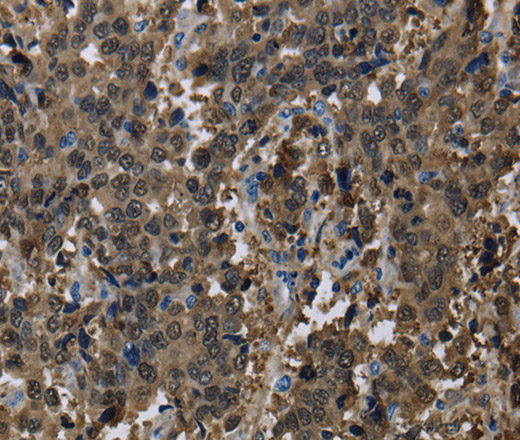 Immunohistochemistry of paraffin-embedded Human liver cancer using GSTA3 Polyclonal Antibody at dilution of 1:30