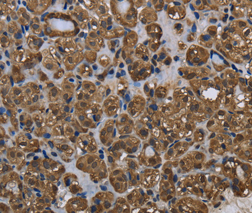 Immunohistochemistry of paraffin-embedded Human thyroid cancer using GSTP1 Polyclonal Antibody at dilution of 1:60