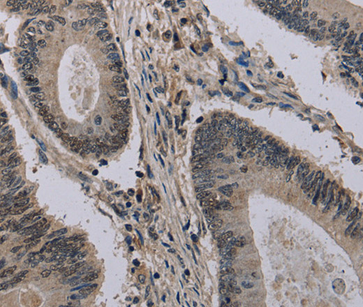 Immunohistochemistry of paraffin-embedded Human colon cancer using HIST1H2AH Polyclonal Antibody at dilution of 1:40