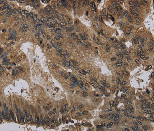 Immunohistochemistry of paraffin-embedded Human colon cancer using Histone H4 Polyclonal Antibody at dilution of 1:30