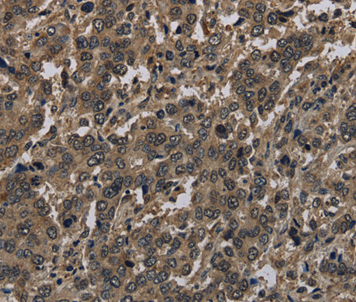 Immunohistochemistry of paraffin-embedded Human liver cancer using Histone H4 Polyclonal Antibody at dilution of 1:30