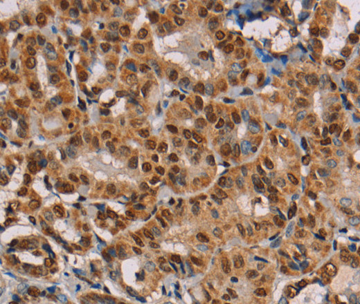 Immunohistochemistry of paraffin-embedded Human thyroid cancer using hnRNP G Polyclonal Antibody at dilution of 1:45