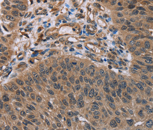 Immunohistochemistry of paraffin-embedded Human lung cancer using HOMER1 Polyclonal Antibody at dilution of 1:50