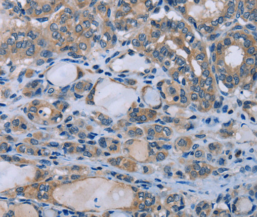 Immunohistochemistry of paraffin-embedded Human thyroid cancer using HOMER1 Polyclonal Antibody at dilution of 1:50