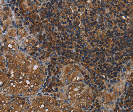 Immunohistochemistry of paraffin-embedded Human thyroid cancer tissue using HOMER2 Polyclonal Antibody at dilution 1:40