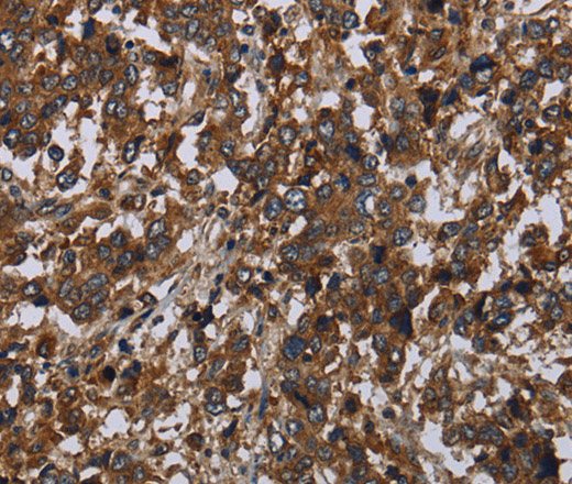 Immunohistochemistry of paraffin-embedded Human liver cancer tissue using HOMER2 Polyclonal Antibody at dilution 1:40