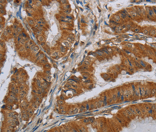 Immunohistochemistry of paraffin-embedded Human esophagus cancer using CSH1 Polyclonal Antibody at dilution of 1:40