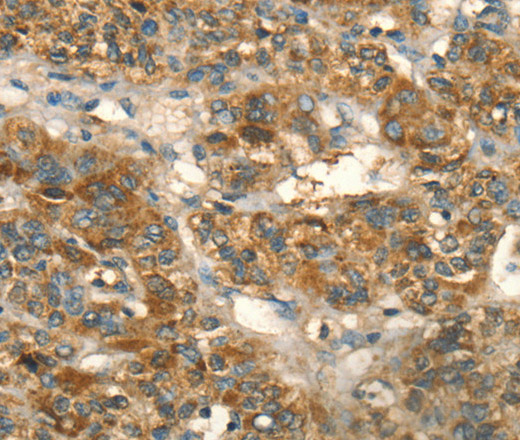 Immunohistochemistry of paraffin-embedded Human liver cancer using HSD17B8 Polyclonal Antibody at dilution of 1:55