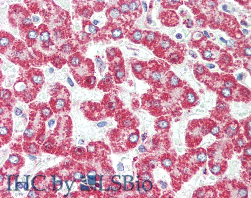 Immunohistochemistry of paraffin-embedded Human liver cancer using HSD17B8 Polyclonal Antibody at dilution of 1:100.