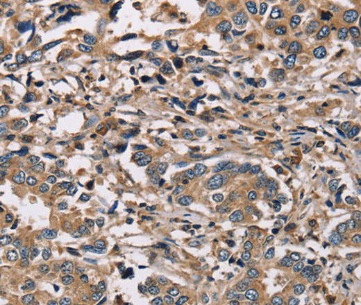 Immunohistochemistry of paraffin-embedded Human liver cancer using HSD17B12 Polyclonal Antibody at dilution of 1:30