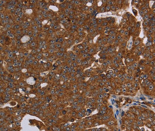 Immunohistochemistry of paraffin-embedded Human ovarian cancer tissue using HSD17B13 Polyclonal Antibody at dilution 1:30