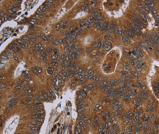 Immunohistochemistry of paraffin-embedded Human colon cancer tissue using HSD17B13 Polyclonal Antibody at dilution 1:30