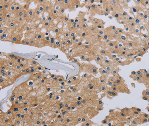 Immunohistochemistry of paraffin-embedded Human prostate cancer tissue using HSD3B7 Polyclonal Antibody at dilution 1:40