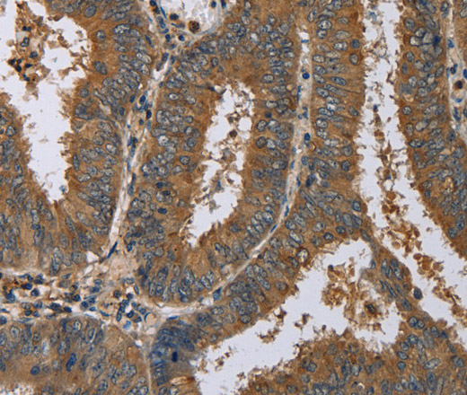 Immunohistochemistry of paraffin-embedded Human colon cancer using HSP40-4 Polyclonal Antibody at dilution of 1:60