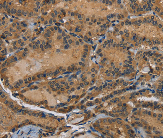 Immunohistochemistry of paraffin-embedded Human thyroid cancer using HSP40-4 Polyclonal Antibody at dilution of 1:60