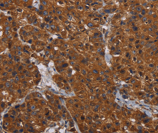 Immunohistochemistry of paraffin-embedded Human breast cancer tissue using HYAL2 Polyclonal Antibody at dilution 1:60