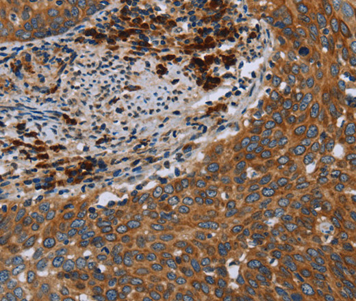 Immunohistochemistry of paraffin-embedded Human cervical cancer using HYAL3 Polyclonal Antibody at dilution of 1:40