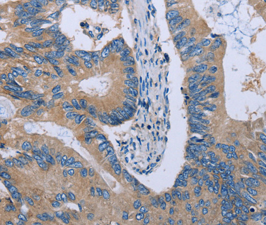 Immunohistochemistry of paraffin-embedded Human colon cancer using HYAL3 Polyclonal Antibody at dilution of 1:40