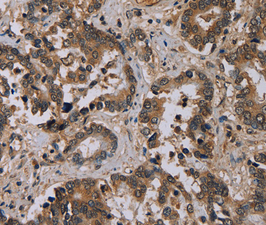 Immunohistochemistry of paraffin-embedded Human liver cancer tissue using CD242 Polyclonal Antibody at dilution 1:30