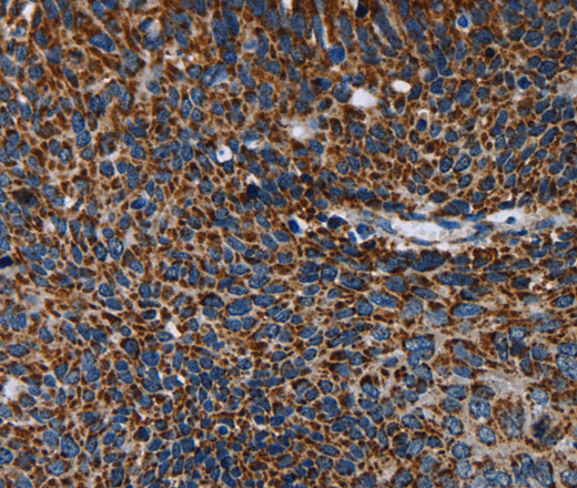 Immunohistochemistry of paraffin-embedded Human cervical cancer using IDH2 Polyclonal Antibody at dilution of 1:60