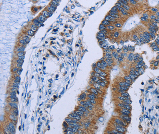 Immunohistochemistry of paraffin-embedded Human colon cancer using IDH2 Polyclonal Antibody at dilution of 1:60