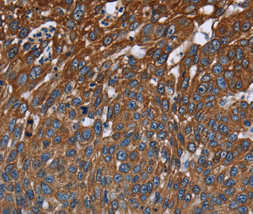 Immunohistochemistry of paraffin-embedded Human lung cancer tissue using FCGR3A Polyclonal Antibody at dilution 1:40