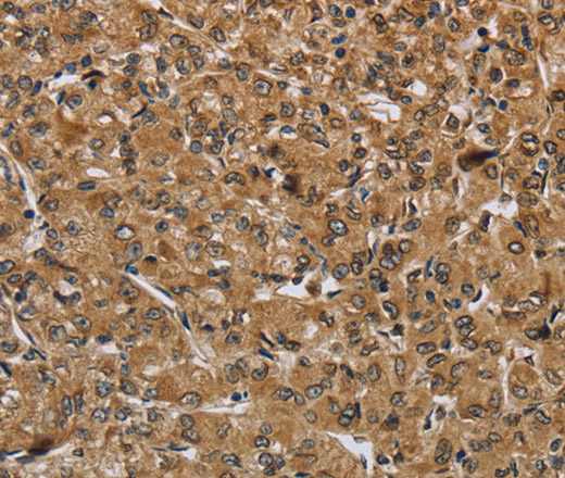 Immunohistochemistry of paraffin-embedded Human prostate cancer tissue using IKBIP Polyclonal Antibody at dilution 1:40