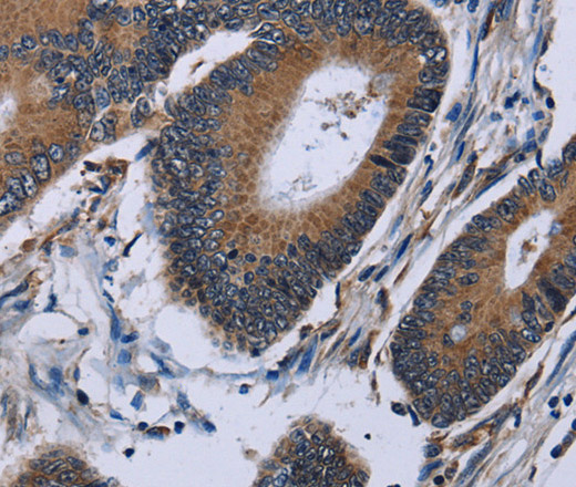 Immunohistochemistry of paraffin-embedded Human colon cancer using IPO4 Polyclonal Antibody at dilution of 1:50