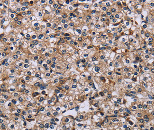 Immunohistochemistry of paraffin-embedded Human prostate cancer using IPO4 Polyclonal Antibody at dilution of 1:50