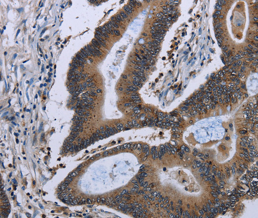 Immunohistochemistry of paraffin-embedded Human ovarian cancer tissue using ITGAE Polyclonal Antibody at dilution of 1:50