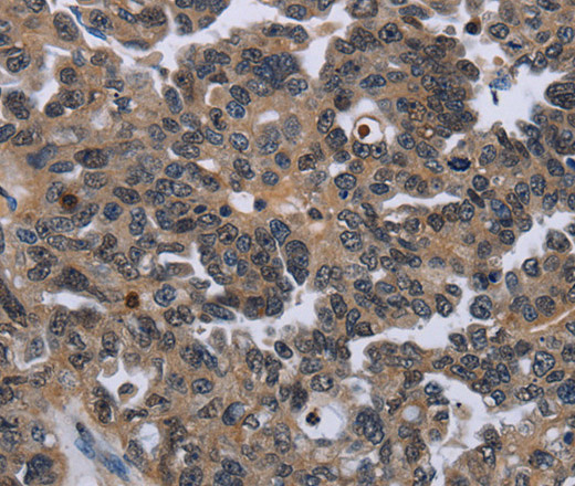 Immunohistochemistry of paraffin-embedded Human ovarian cancer using ITGAE Polyclonal Antibody at dilution of 1:50