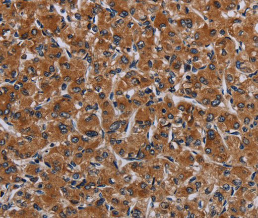 Immunohistochemistry of paraffin-embedded Human prostate cancer tissue using IRGM Polyclonal Antibody at dilution 1:50