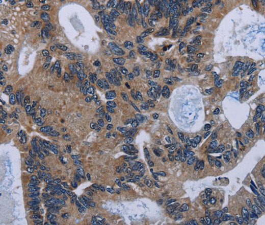 Immunohistochemistry of paraffin-embedded Human colon cancer tissue using IRGM Polyclonal Antibody at dilution 1:50