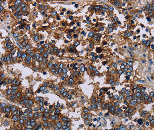 Immunohistochemistry of paraffin-embedded Human liver cancer using JAM-A Polyclonal Antibody at dilution of 1:40