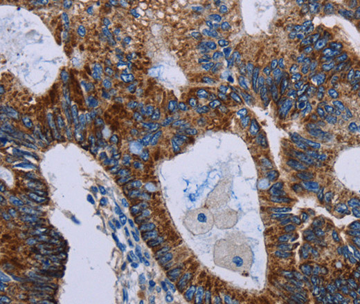 Immunohistochemistry of paraffin-embedded Human colon cancer using JAM-A Polyclonal Antibody at dilution of 1:40