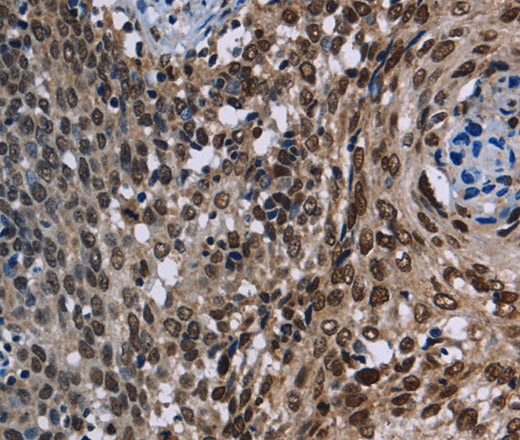 Immunohistochemistry of paraffin-embedded Human cervical cancer using KDM3B Polyclonal Antibody at dilution of 1:40