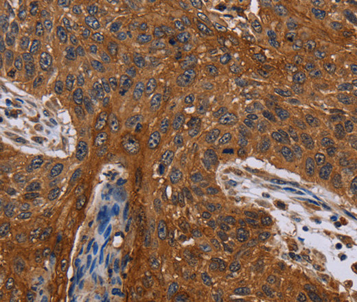 Immunohistochemistry of paraffin-embedded Human lung cancer using Catenin gamma Polyclonal Antibody at dilution of 1:40