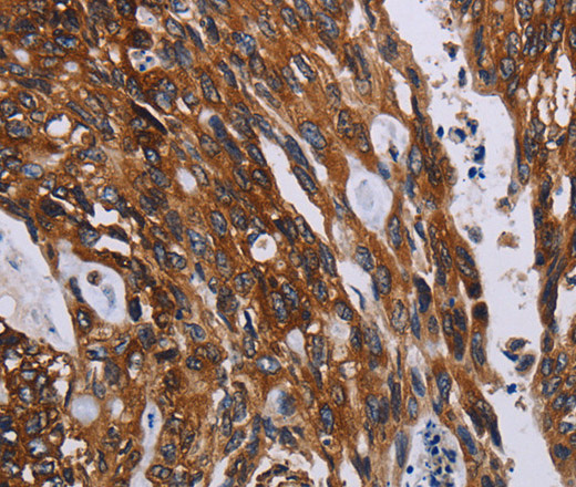 Immunohistochemistry of paraffin-embedded Human colon cancer using KARS Polyclonal Antibody at dilution of 1:60