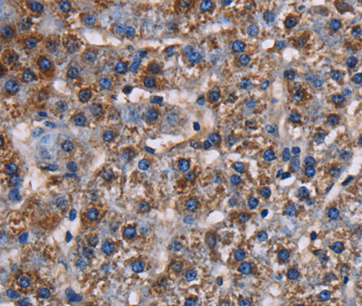 Immunohistochemistry of paraffin-embedded Human lung cancer tissue using KCNK1 Polyclonal Antibody at dilution 1:50