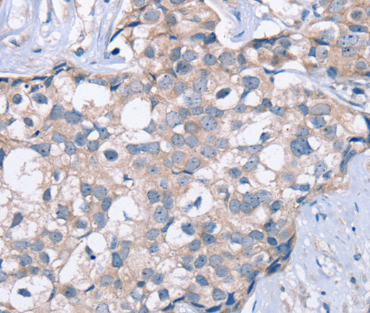 Immunohistochemistry of paraffin-embedded Human breast cancer tissue using KCNQ5 Polyclonal Antibody at dilution 1:60