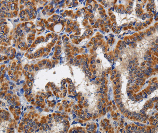 Immunohistochemistry of paraffin-embedded Human thyroid cancer tissue using KLK6 Polyclonal Antibody at dilution 1:60