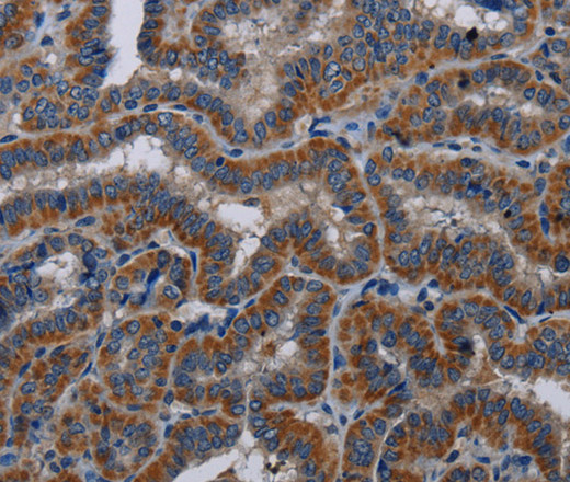 Immunohistochemistry of paraffin-embedded Human thyroid cancer tissue using KLK11 Polyclonal Antibody at dilution 1:40