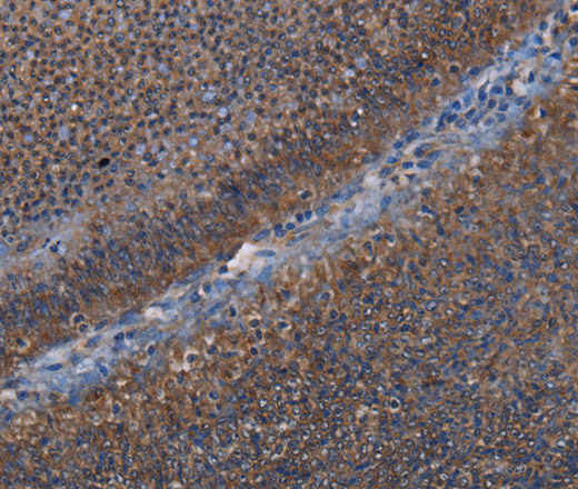 Immunohistochemistry of paraffin-embedded Human rectal cancer using P3H3 Polyclonal Antibody at dilution of 1:50