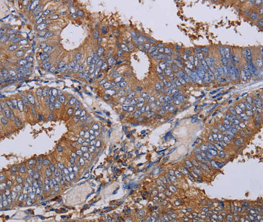 Immunohistochemistry of paraffin-embedded Human colon cancer using LIMS1 Polyclonal Antibody at dilution of 1:40