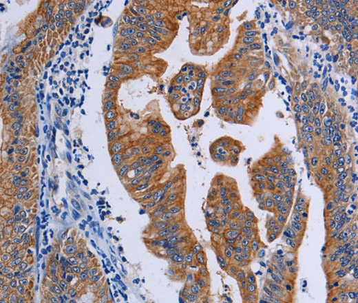 Immunohistochemistry of paraffin-embedded Human gasrtic cancer tissue using ACP6 Polyclonal Antibody at dilution 1:50