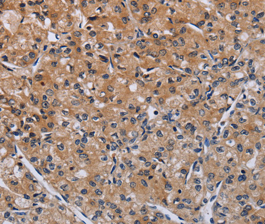 Immunohistochemistry of paraffin-embedded Human prostate cancer tissue using ACP6 Polyclonal Antibody at dilution 1:50