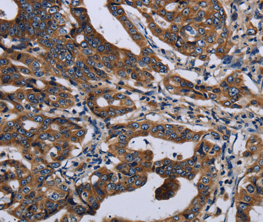 Immunohistochemistry of paraffin-embedded Human gastic cancer using LZTFL1 Polyclonal Antibody at dilution of 1:50